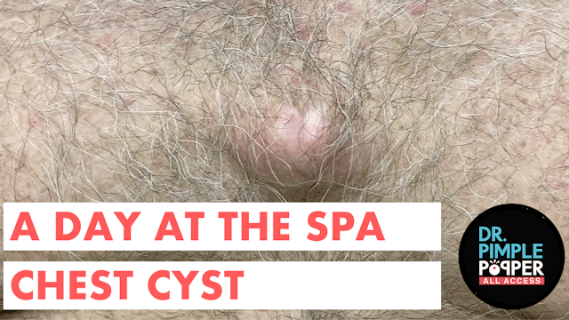 A Day at the Spa Chest Cyst