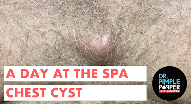 A Day at the Spa Chest Cyst