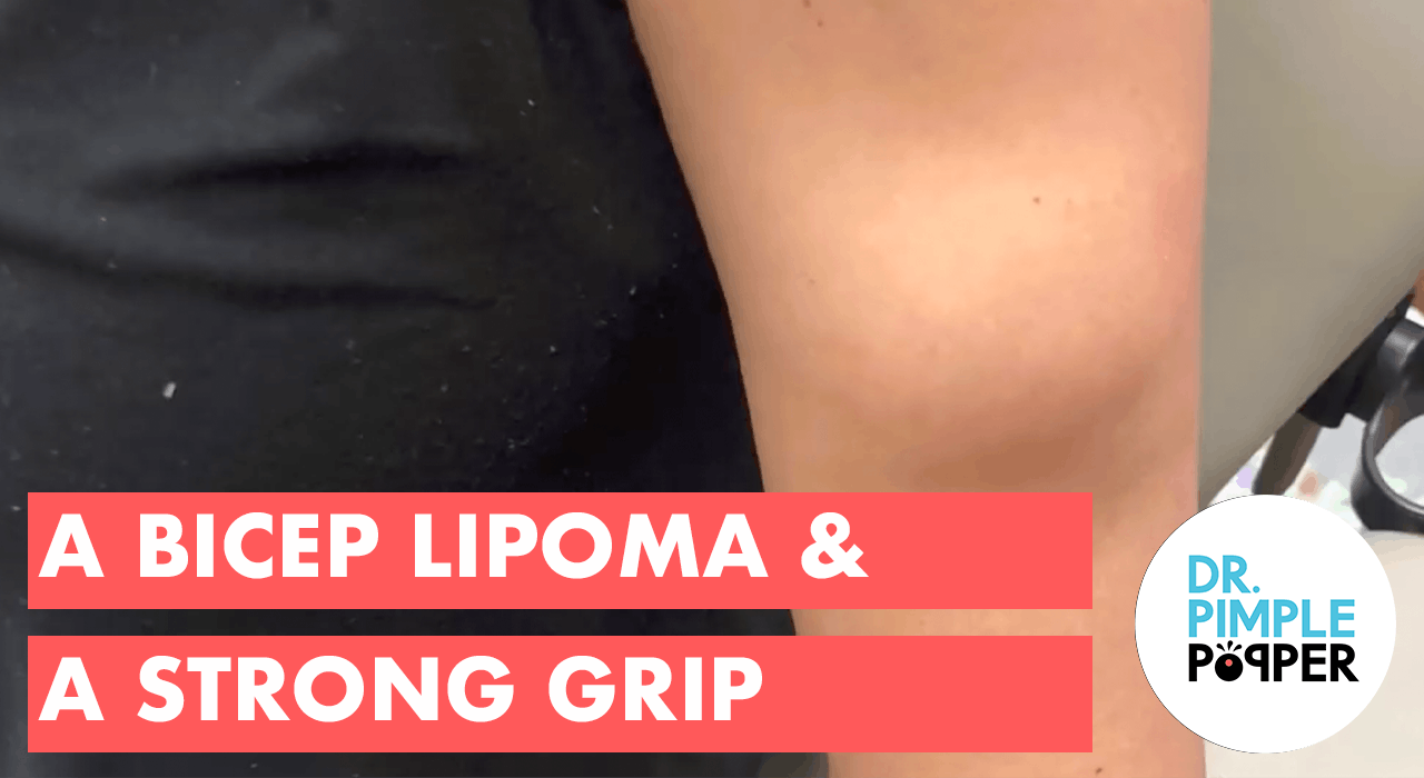 A Bicep Lipoma & A Strong Grip - Lipoma Love - Dr. Pimple Popper