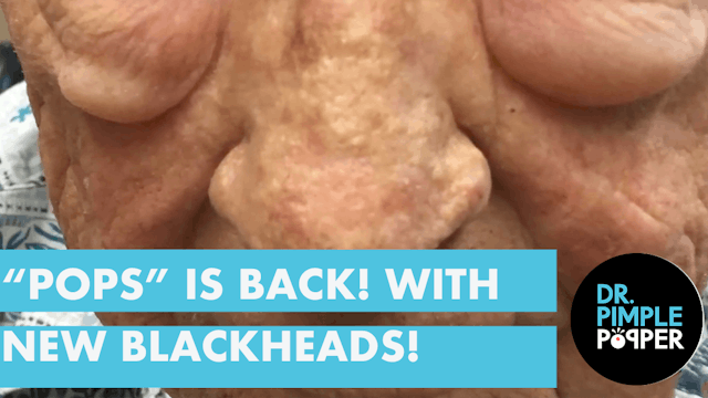 "Pops" is Back! New Blackhead Extractions!