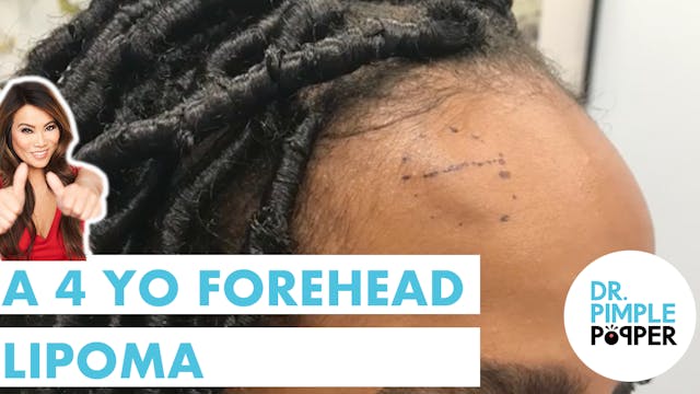 A Fastidious Forehead Lipoma