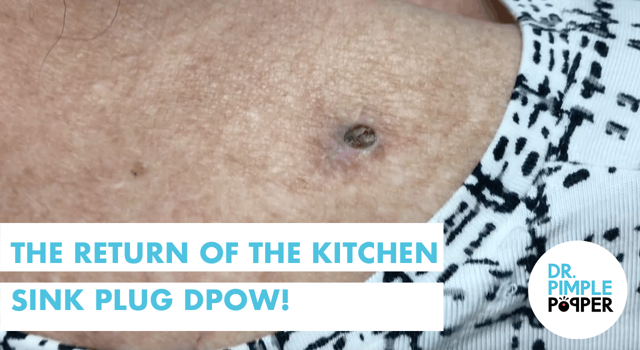 The Return of The Kitchen Sink Plug Dilate Pore of Winer! - Dr. Pimple ...