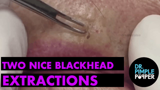 Just Two Nice Blackhead Extractions