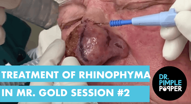 Treatment of Nose Rhinophyma in Mr Go...