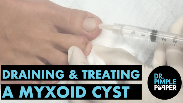 Draining and Treating a Myxoid Cyst