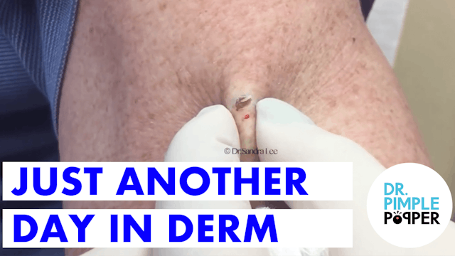 Just Another Day in Derm: Dr. Pimple ...