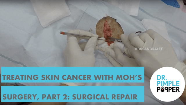 Treating Skin Cancer with Mohs surgery: Part 2, Surgical Repair, Filmed with GoPro