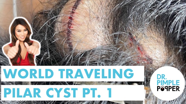 World Traveling Pilar Cyst: Part 1