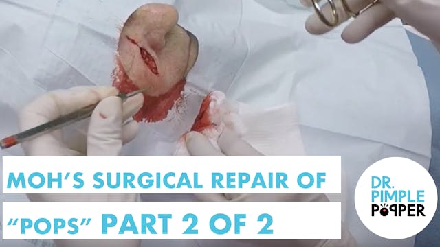 Surgical repair of a Skin Cancer afte...