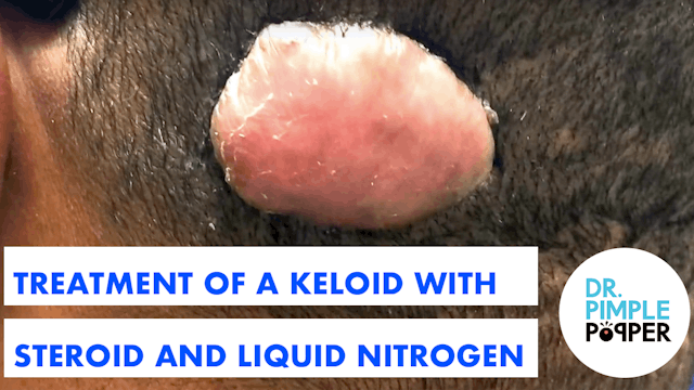 Treatment of a Keloid with Steroid and Liquid Nitrogen