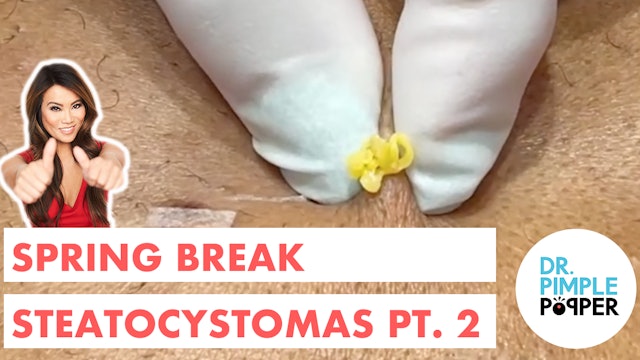 Spring Break Steatocystomas Part 2