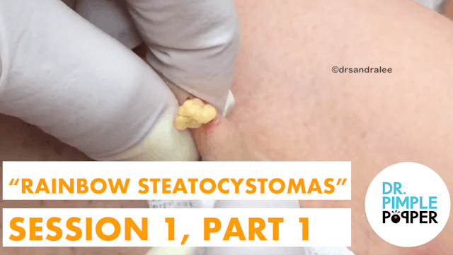Meet "Rainbow Steatocystoma": Session One, Part One