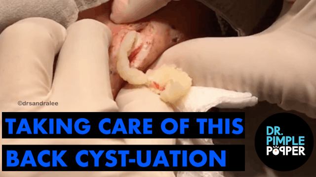 Let's Take Care of this Back Cyst - u...