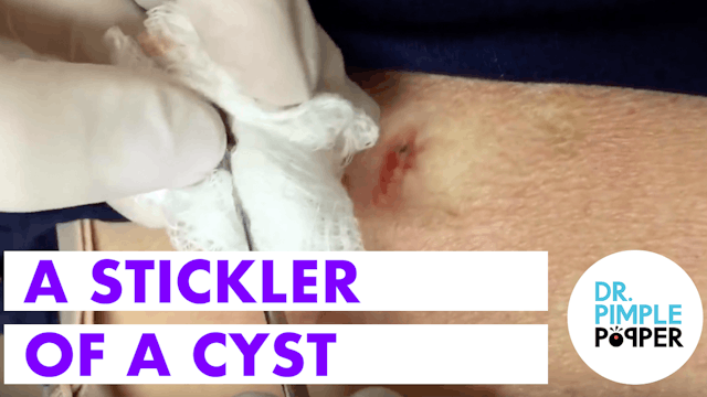 A Stickler of a Cyst