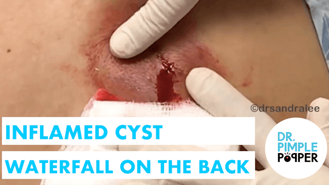 Inflamed Cyst Waterfall on the Back w...