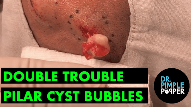 Double Trouble Pilar Cyst Bubbles