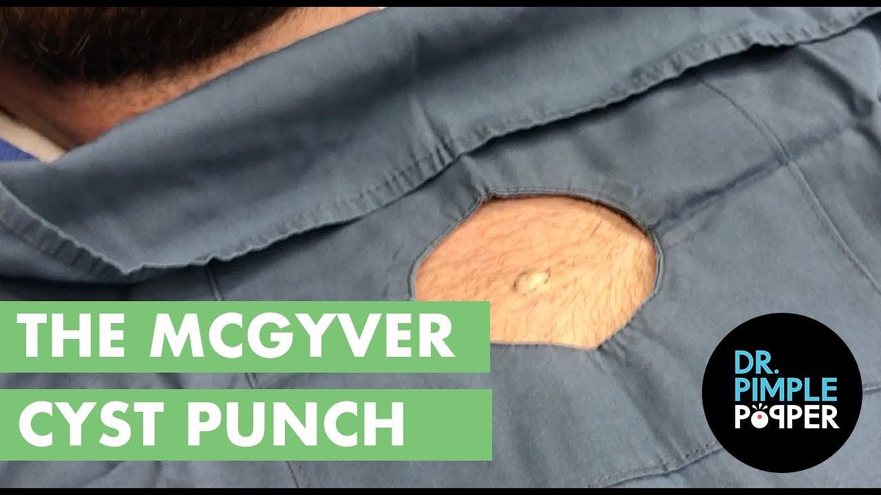 The MacGyver Cyst Punch Dr. Pimple Popper
