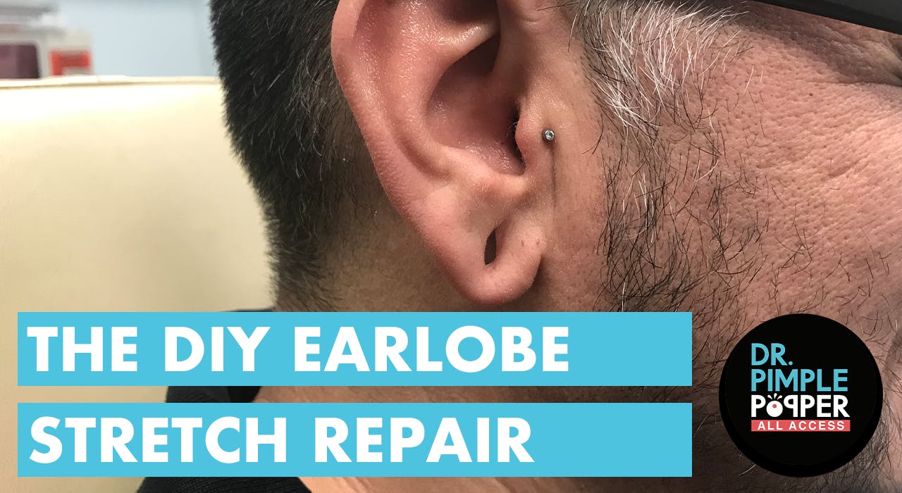 The DIY Earlobe Stretch Repair Dr. Pimple Popper