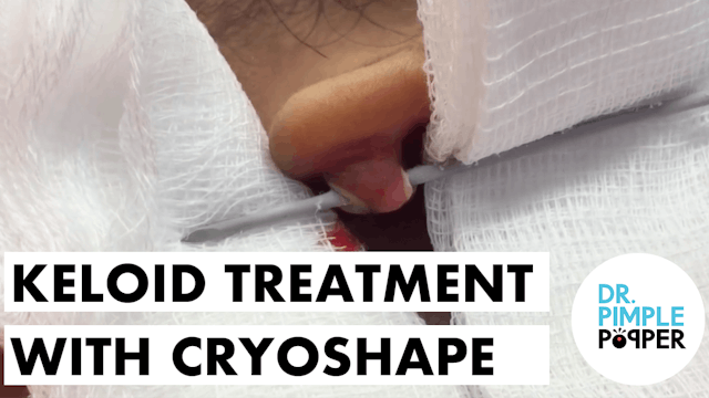 Keloid Treatment with Cryoshape
