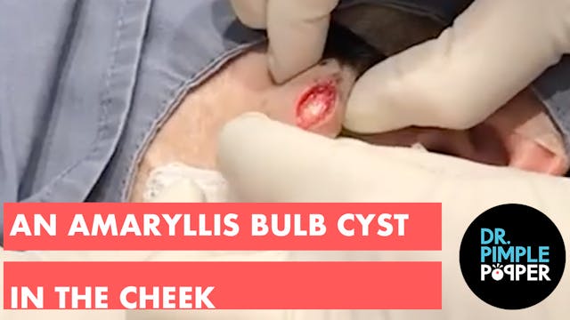An Amaryllis Bulb Cyst in the Cheek