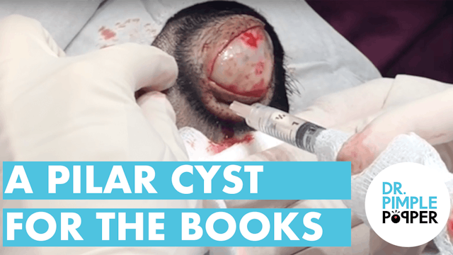 A Pilar Cyst For the Books