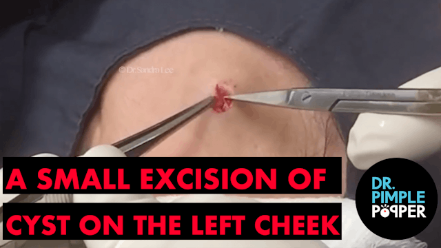 A Small Excision of the Cyst on the L...