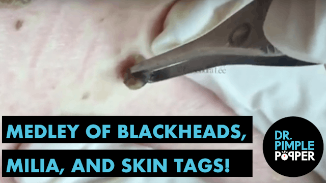Medley of Blackheads, Milia & Skin Tags!