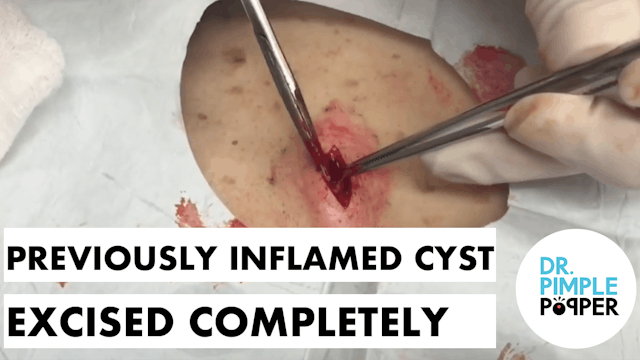 Previously Inflamed Cyst on the Neck