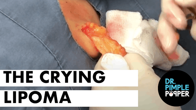 The Crying Lipoma