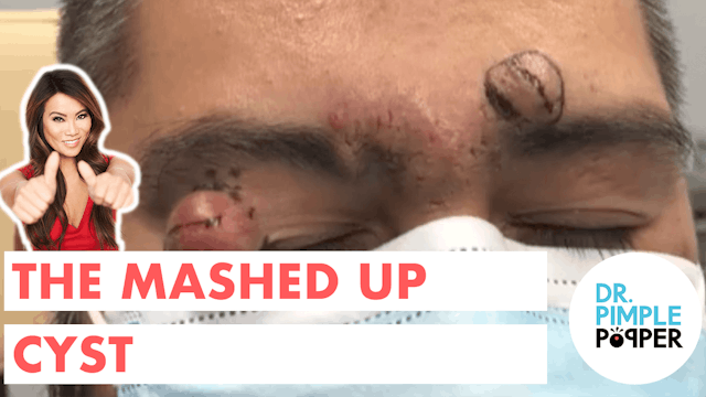 Queen of Pops' Pick: The Mashed Up Cyst