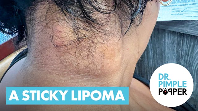 A Sticky Lipoma