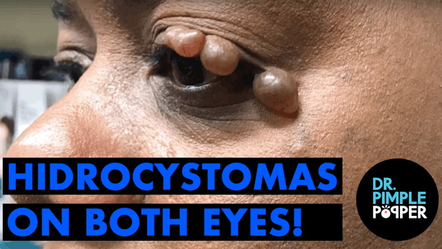 Hidrocystomas on both eyes!
