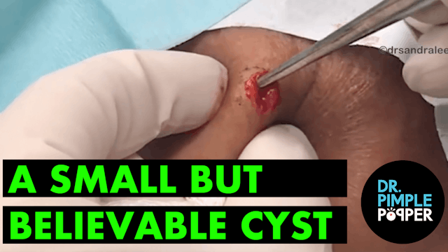 A Small but Believable Cyst