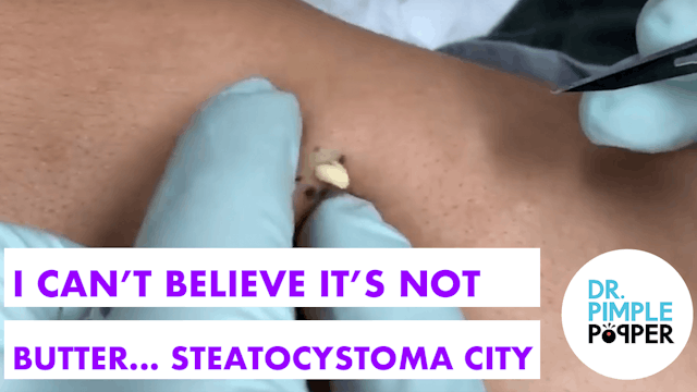 I Can't Believe It's Not Butter... Steatocystoma City