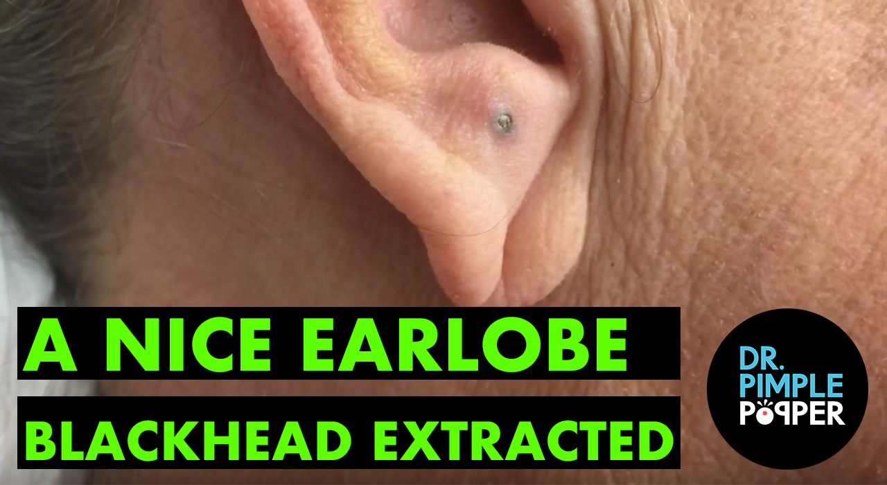 A Nice Earlobe Blackhead - Dr. Pimple Popper