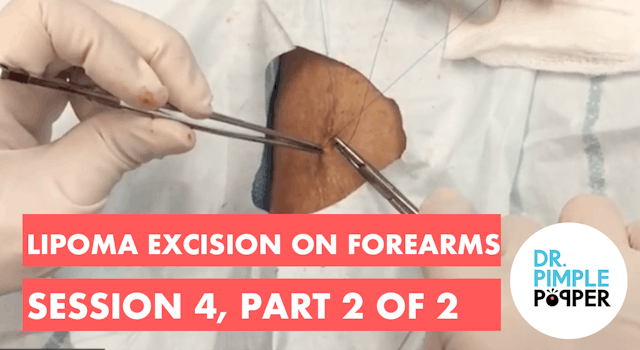 Lipoma excision on forearms, Session ...