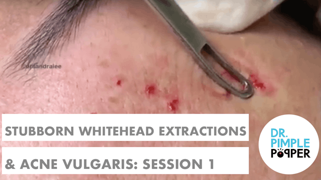 Stubborn Whitehead extractions & Acne...