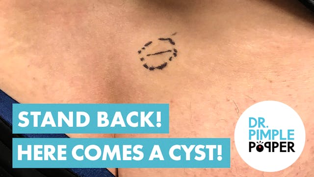 Stand Back! Cyst Removal & Cut