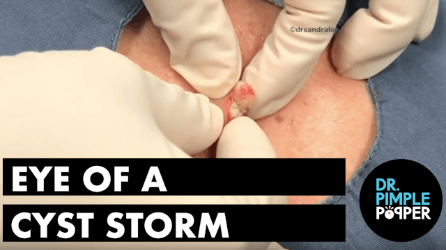 Eye of a Cyst Storm