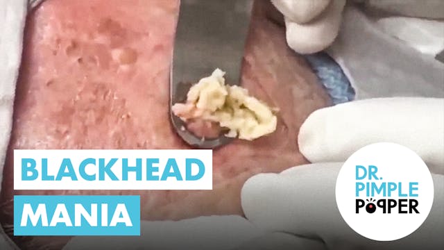 Blackhead Mania