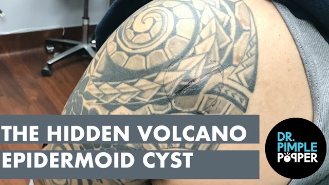 A Hidden Volcano Cyst