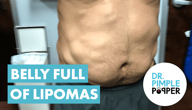 Belly Full of Lipomas