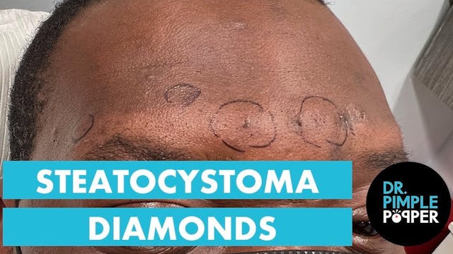 Steatocystoma Diamonds!