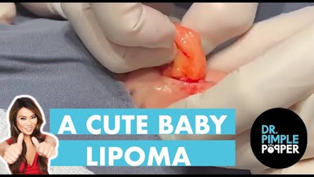 A Cute Baby Lipoma