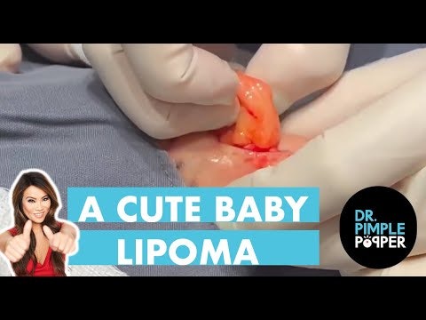 A Cute Baby Lipoma