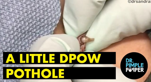 A Little DPOW Pothole