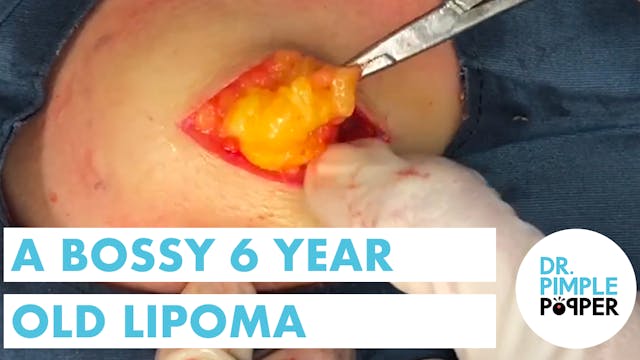 A Bossy 6 Year Old Lipoma