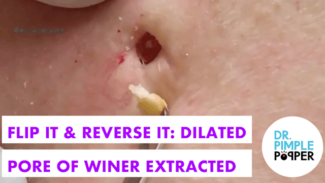 Flip it & Reverse it Blackhead Extraction / Dilated Pore of Winer