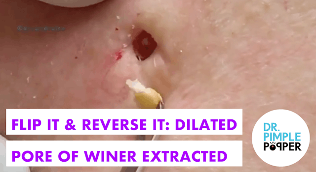 Flip it & Reverse it Blackhead Extraction / Dilated Pore of Winer