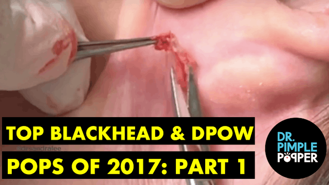 Dr Pimple Popper's Top Blackhead & DPOW POPS of 2017! Part 1